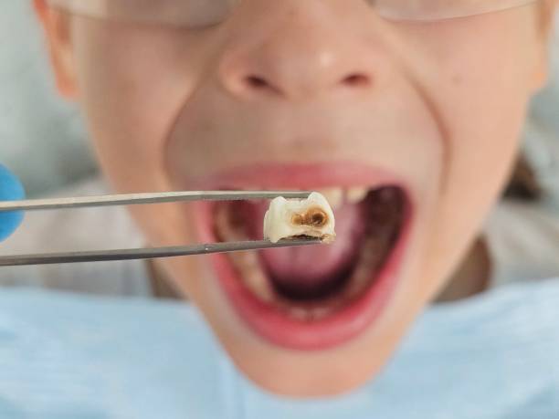 Best Dental Abscess Treatment in Lombard, IL